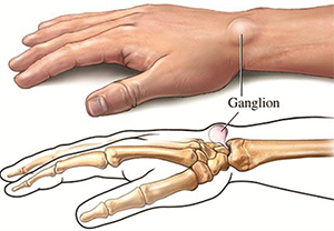 izületes ujjak kezelése artrózis a térd 3 fokában